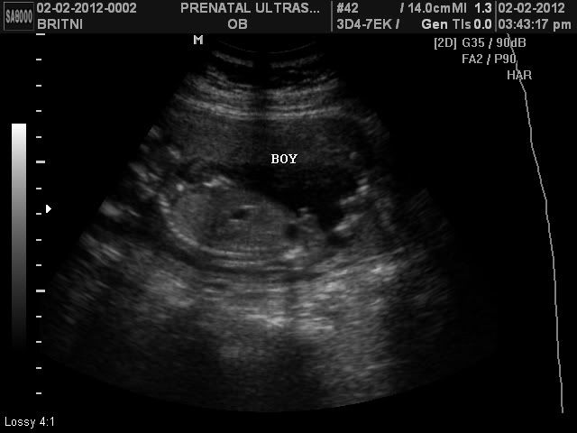 boy gender scan